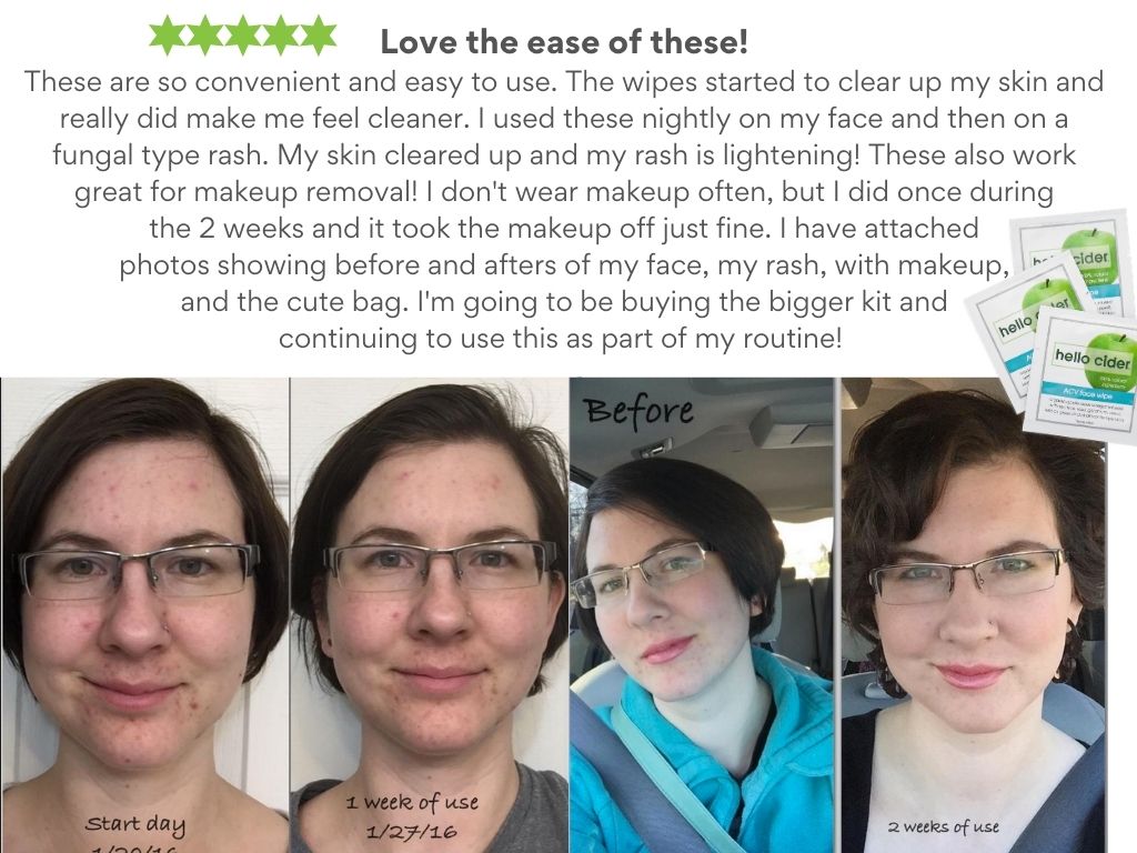 ACV Acne Face Wipe - Hello Cider